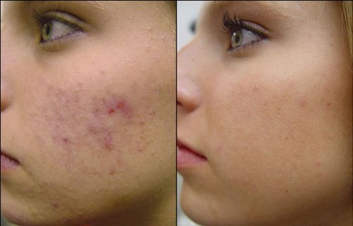 eliminar el acne